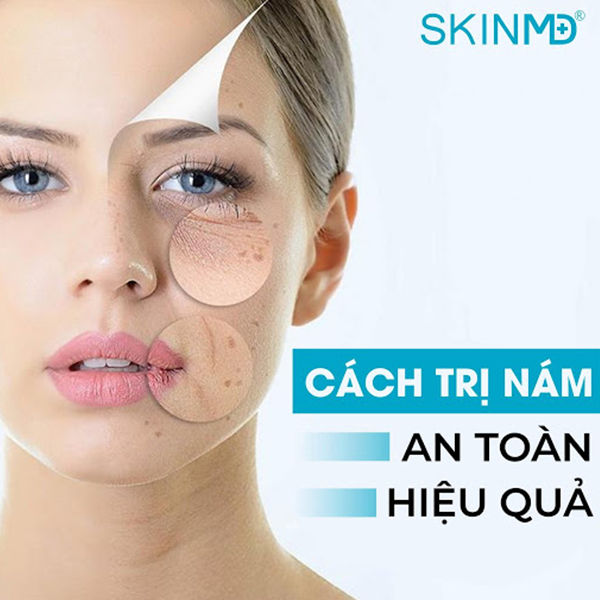 “Da nám” không còn lo lắng với 3 dòng sản phẩm skinmd được hơn 1000 bác sĩ da liễu châu Á tin dùng