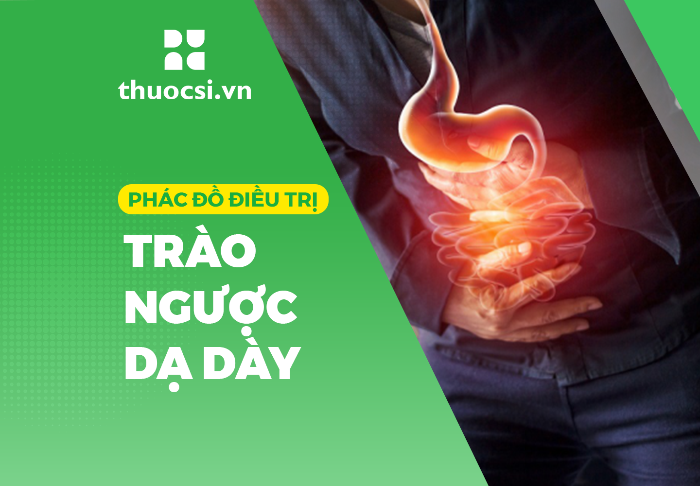 Phác đồ điều trị trào ngược dạ dày